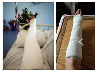 解密跟腱断裂术后制动期