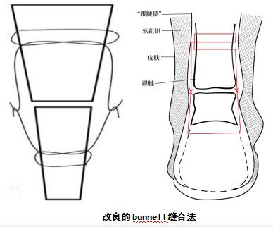 聚创伤骨科精英论跟腱微创缝合