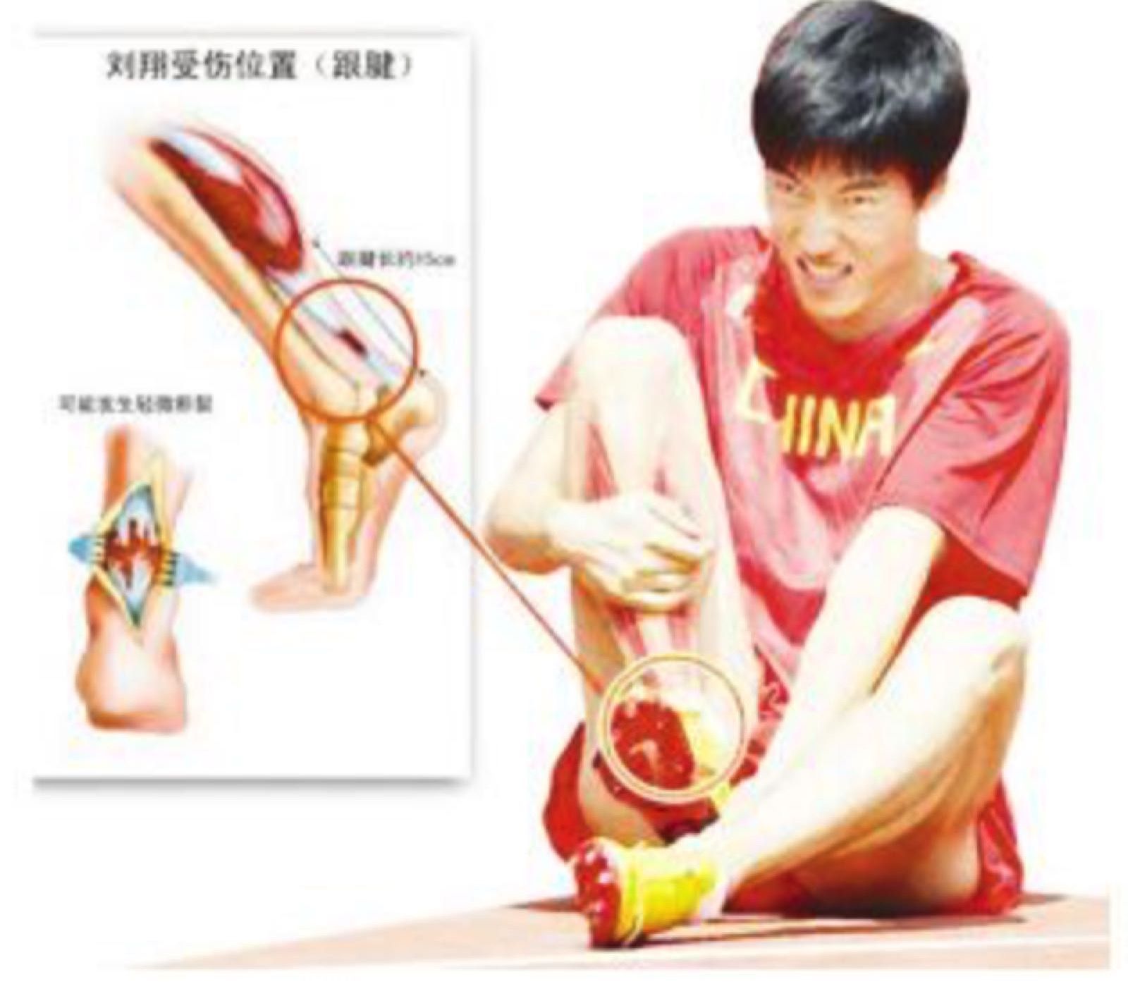3例跟腱断裂的微创治疗