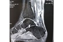 武汉同济医院完成首例“微创跟腱断裂通道吻合术”