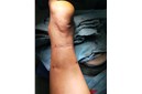 治疗跟腱断裂，湖南省人民医院又前进一步！